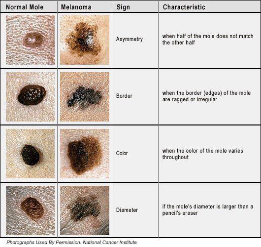 skin cancer pic national cancer institue